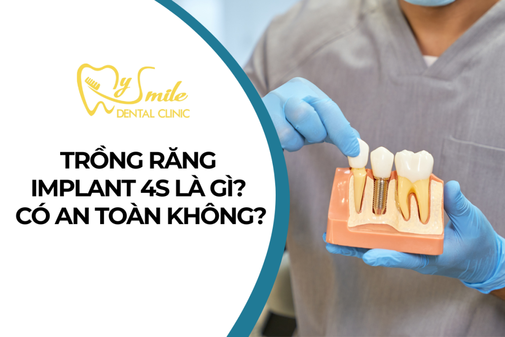 Trồng răng Implant 4S là gì? Có an toàn không?