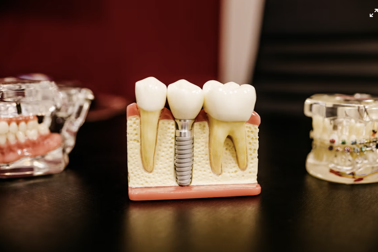 trồng răng implant