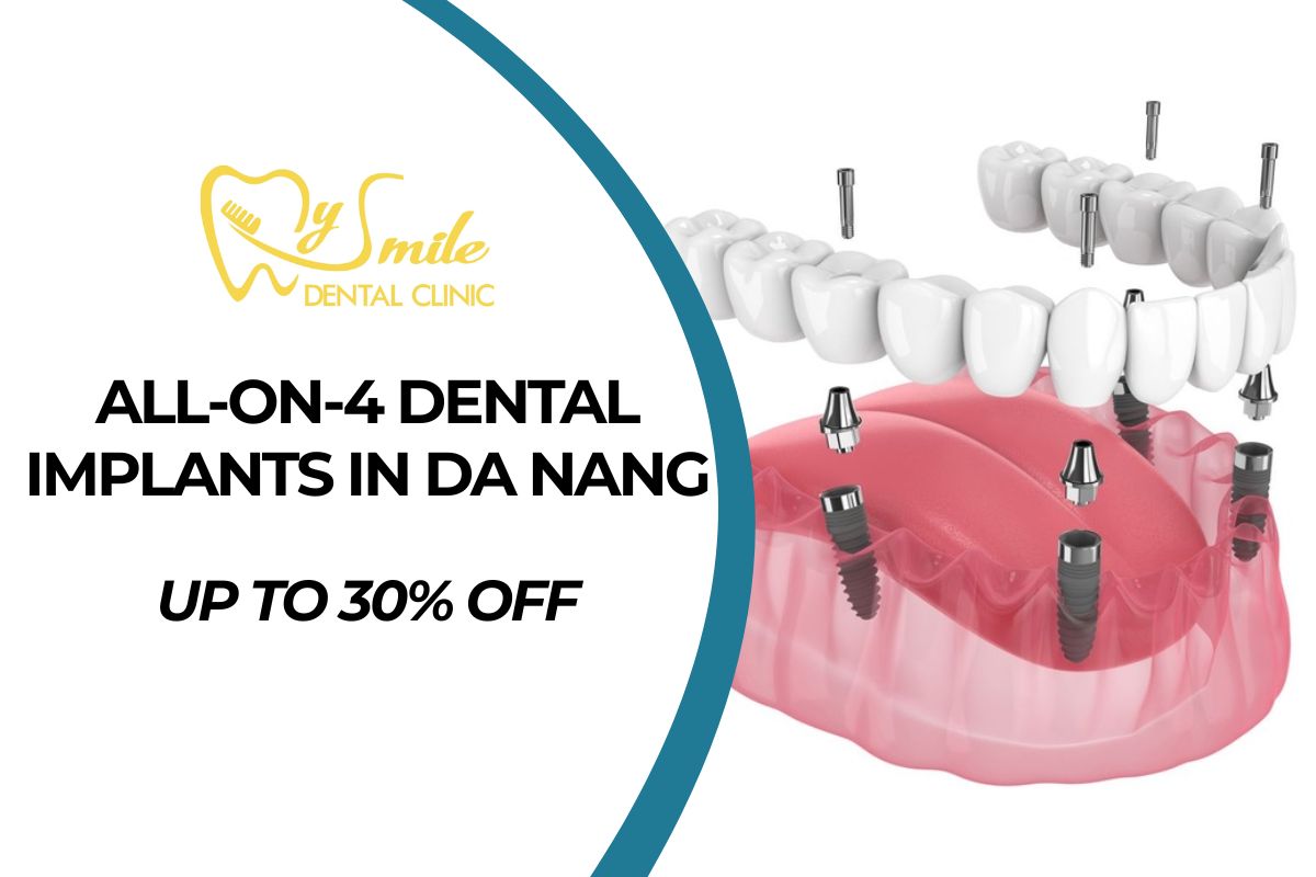 Full-Arch All-on-4 Dental Implants in Da Nang - Up to 30% Off