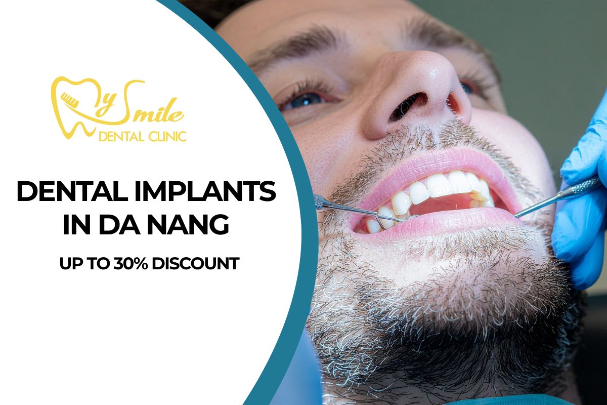 Dental Implants in Da Nang – Up to 30% Discount
