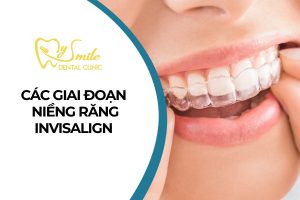 Các giai đoạn niềng răng Invisalign cần biết