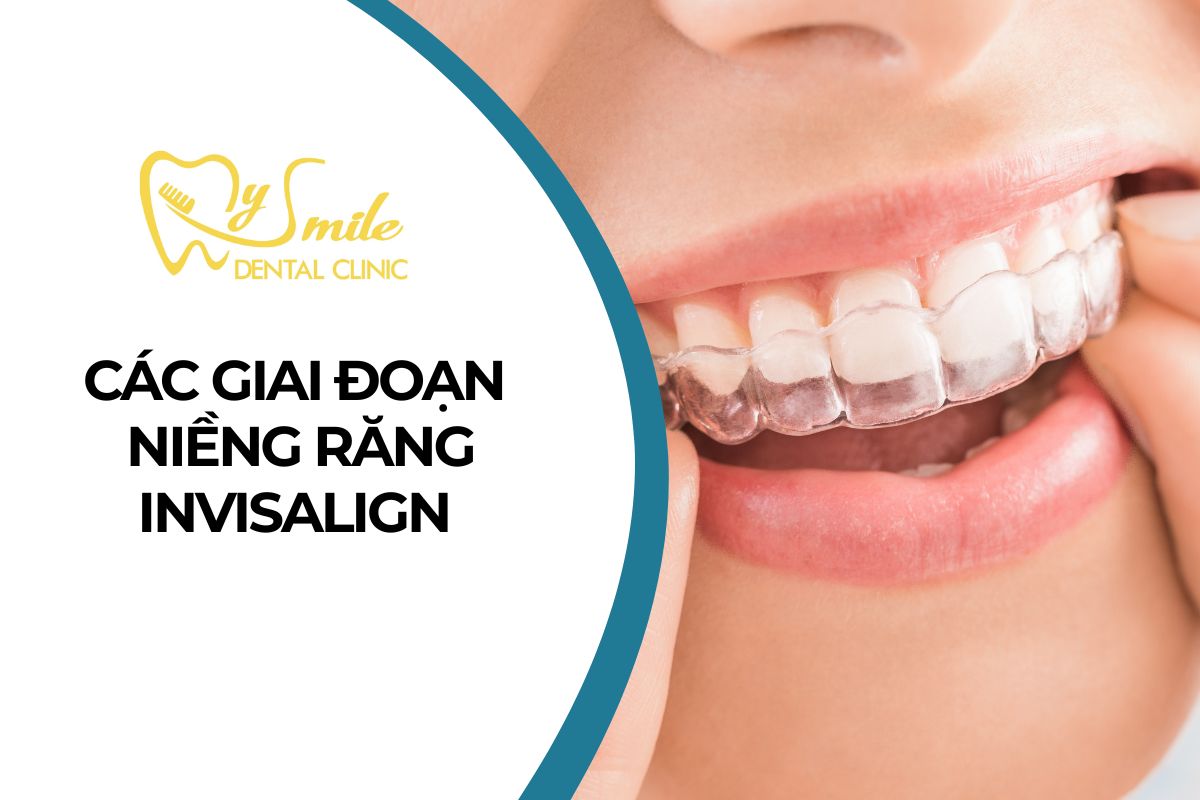 Các giai đoạn niềng răng Invisalign cần biết
