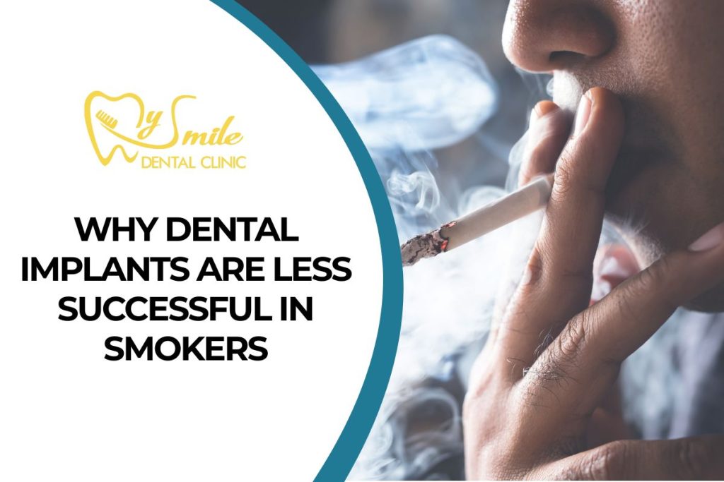 Why Dental Implants Are Less Successful in Smokers