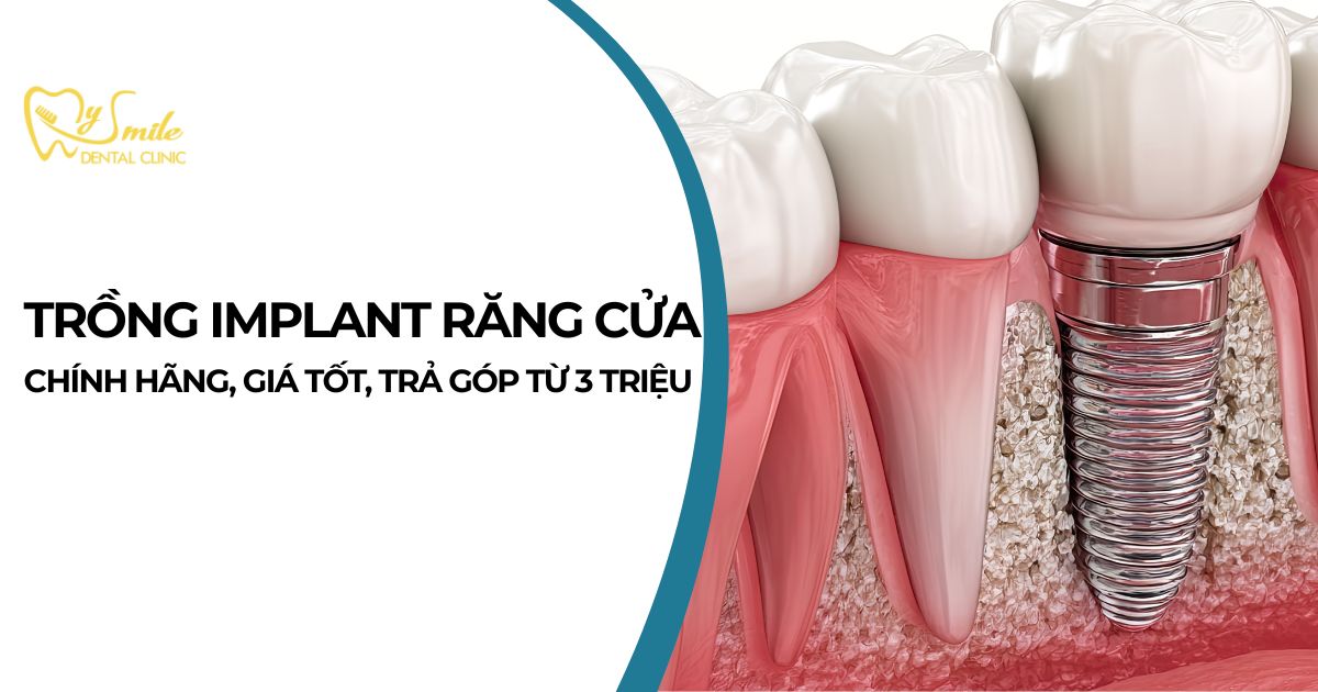 Trồng Implant răng cửa