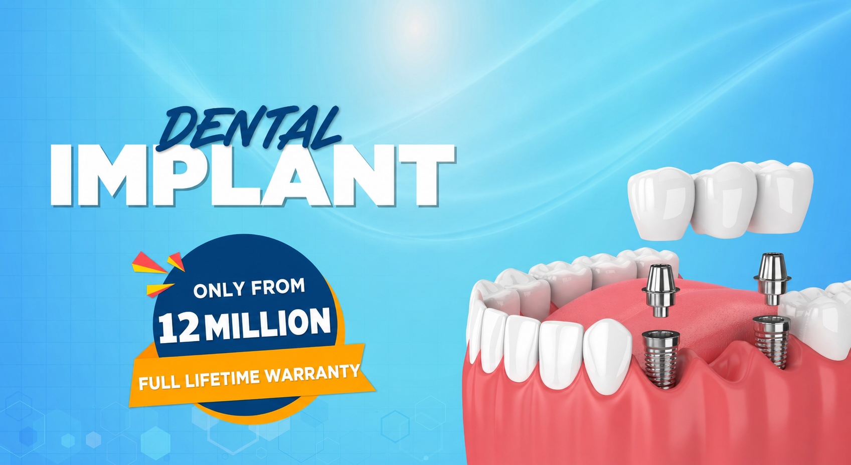 High-quality dental implants in Da Nang