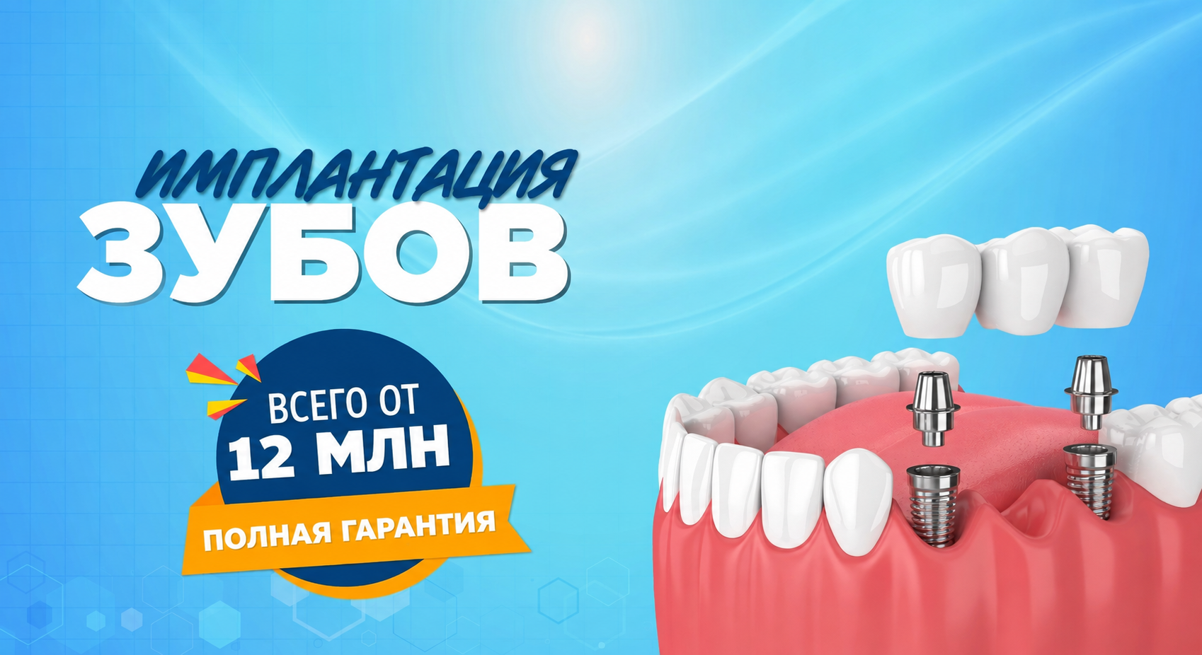 Качественные зубные имплантаты в Дананге
