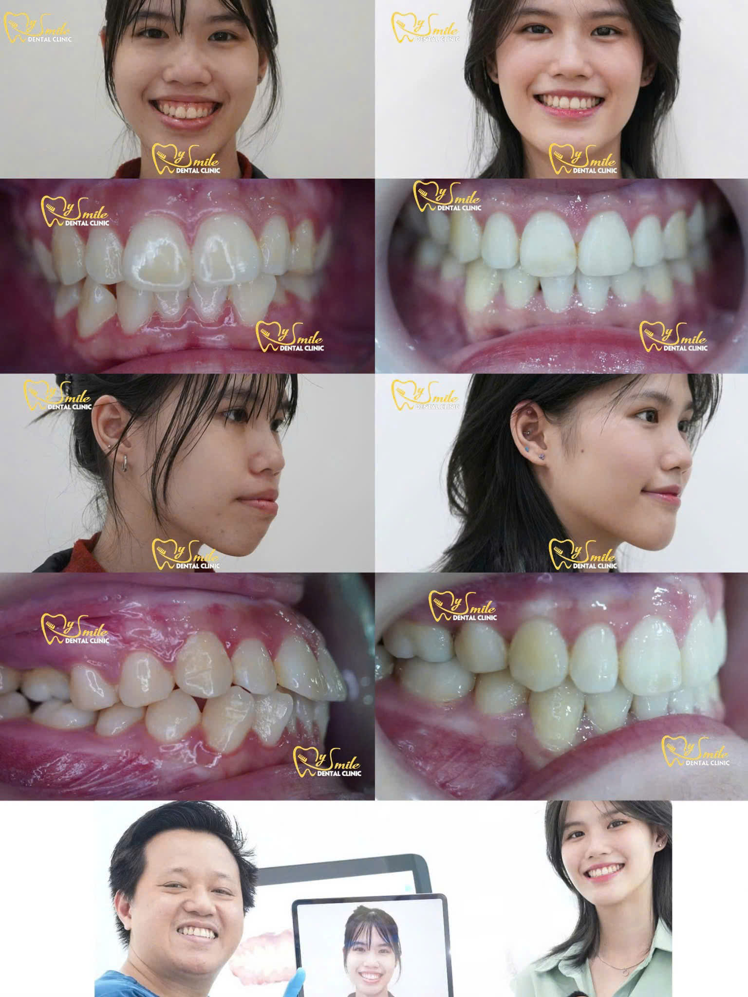 Khách hàng chia sẻ sự hài lòng về kết quả điều trị và quy trình tư vấn kỹ lưỡng khi chụp CT Cone Beam tại My Smile