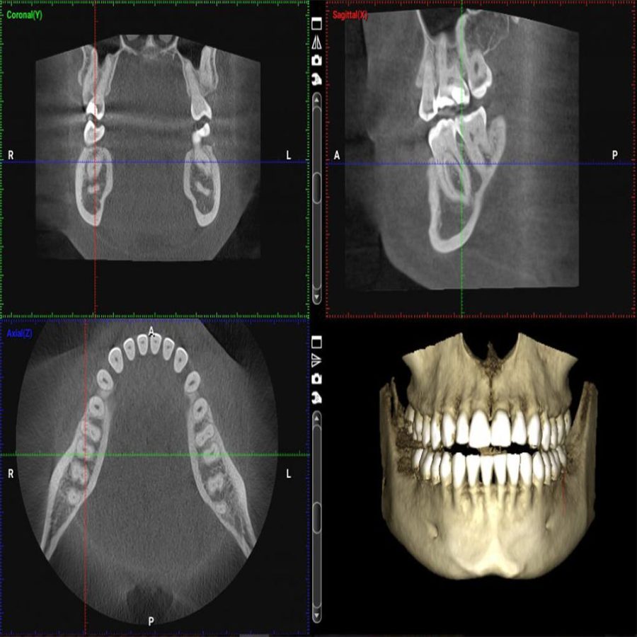 Dữ liệu phim chụp CT Cone Beam 3D tích hợp phần mềm nha khoa kỹ thuật số giúp bác sĩ phân tích và lập kế hoạch điều trị chính xác