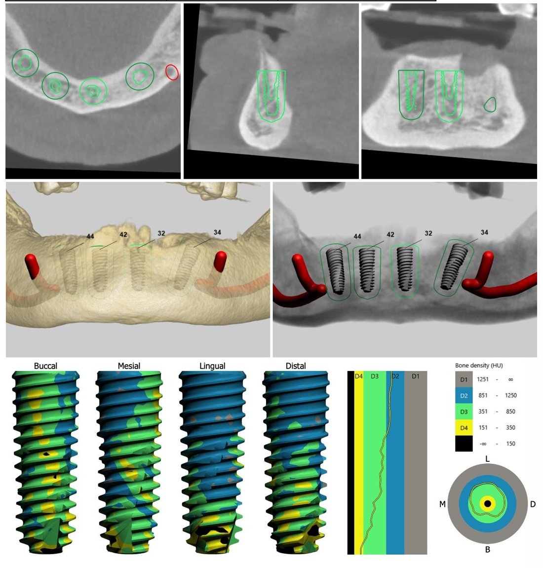 Lên phác đồ và mô phỏng 3D - Bước 2 trồng răng Implant