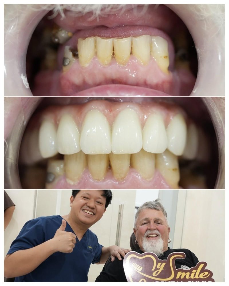 Gắn răng hoàn thiện và hẹn tái khám - Bước 6
