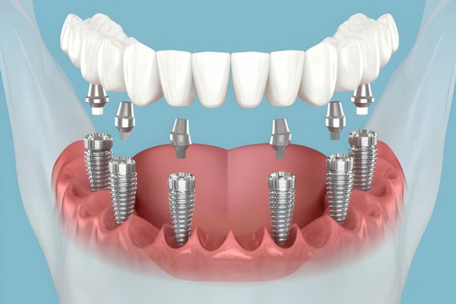 Quy trình trồng Implant phục hồi răng mất được xây dựng chuẩn y khoa và chi tiết cho từng bước điều trị