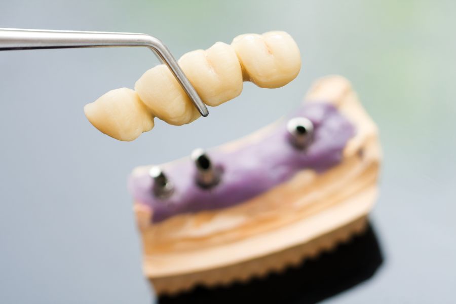 Mô hình cấu trúc trụ Implant được ứng dụng trong quy trình trồng răng chuyên sâu tại Nha khoa My Smile Đà Nẵng