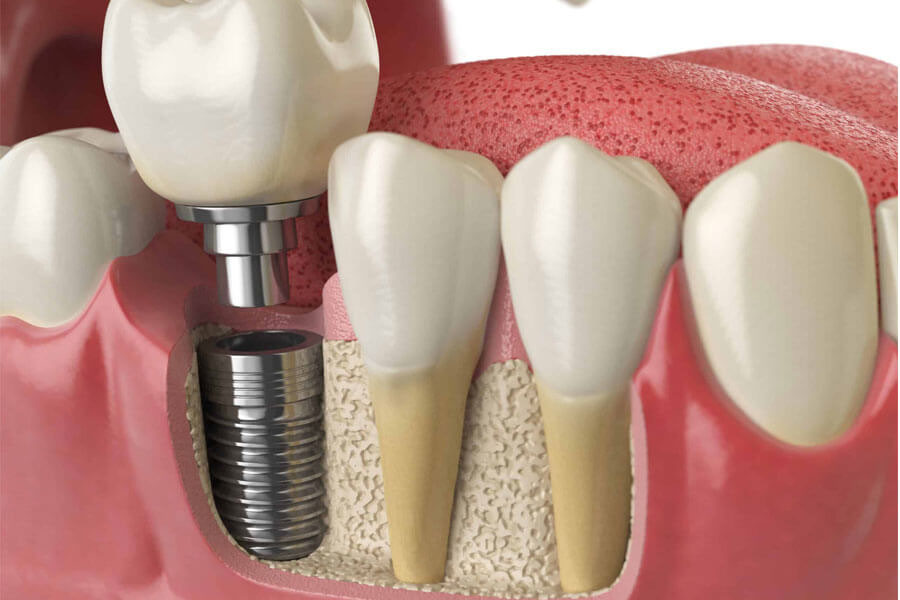 Trồng răng Implant không gây đau đớn nhờ kỹ thuật gây tê cục bộ chính xác trước khi thực hiện phẫu thuật