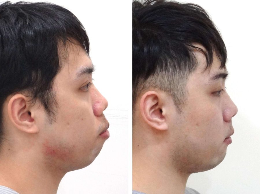Tình trạng răng hô ảnh hưởng trực tiếp đến khuôn mặt khi nhìn nghiêng