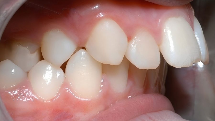 Hình ảnh thực tế khớp cắn sai lệch do hô xương hàm khiến vùng miệng bị đẩy ra trước
