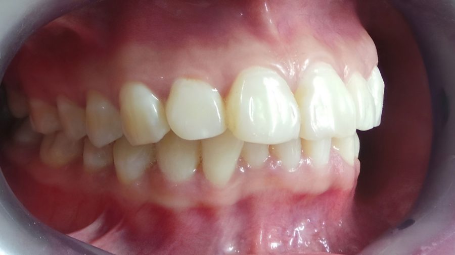 Hình ảnh thực tế tình trạng răng hô mọc chìa về phía trước khiến vùng miệng trông nhô hơn