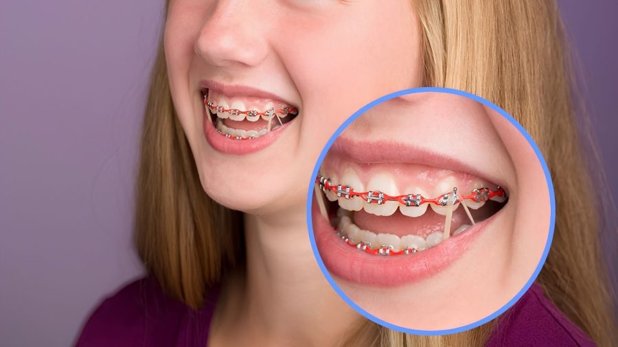 Niềng răng là phương pháp khắc phục hiệu quả tình trạng miệng hô do răng, giúp điều chỉnh khớp cắn về vị trí chuẩn
