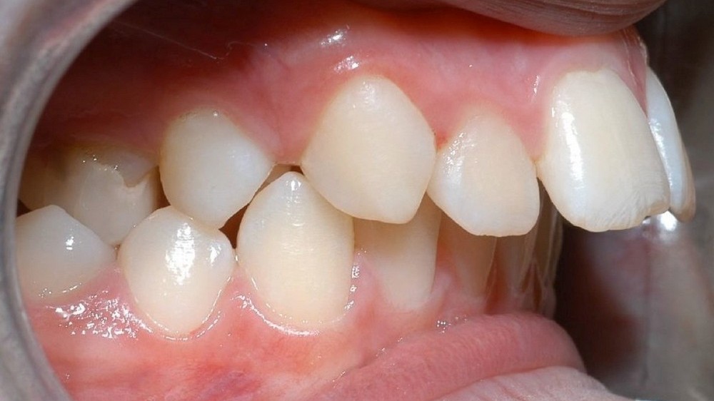 Trường hợp áp dụng niềng răng Invisalign