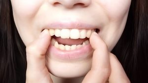 Miệng hô là gì? Nguyên nhân và cách khắc phục hiệu quả