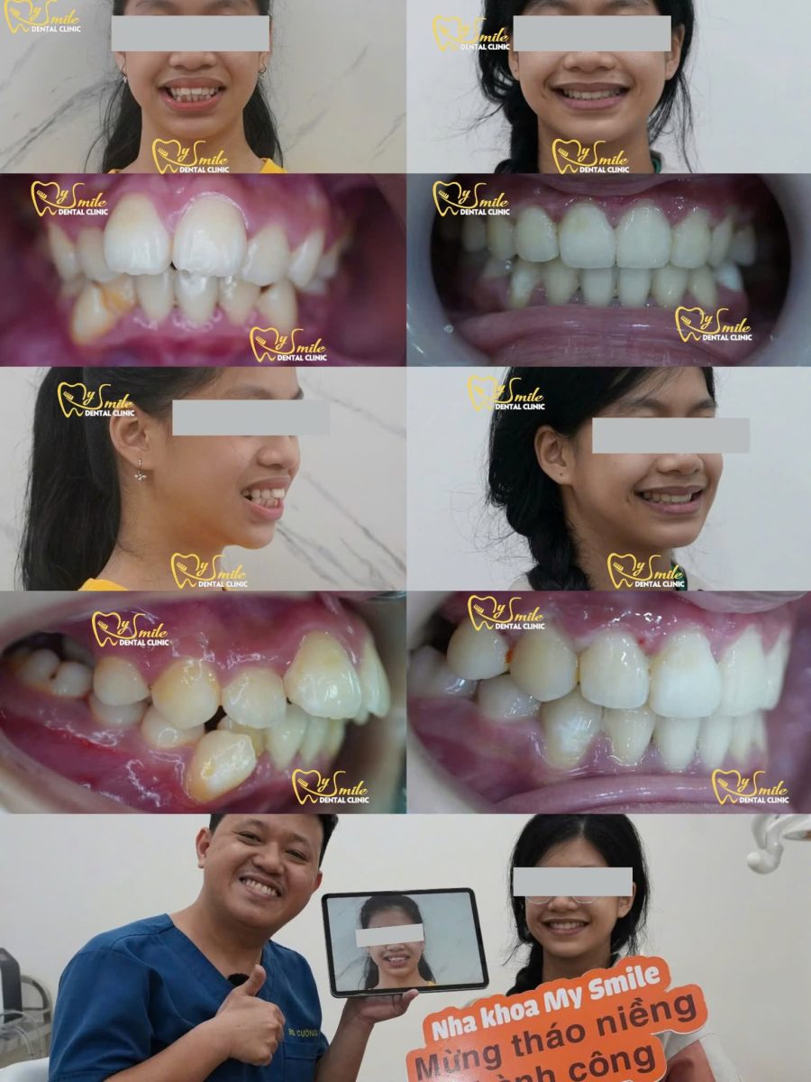Hình ảnh thực tế cải thiện độ nhô vùng miệng và khớp cắn của khách hàng sau khi niềng răng hô tại Nha khoa My Smile