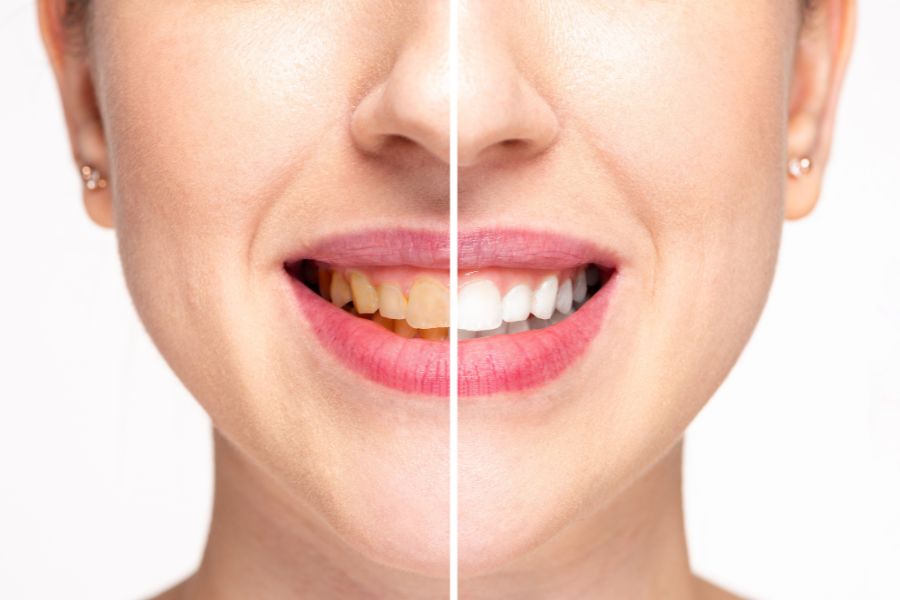 Nên dán sứ hay bọc răng sứ tại Đà Nẵng?