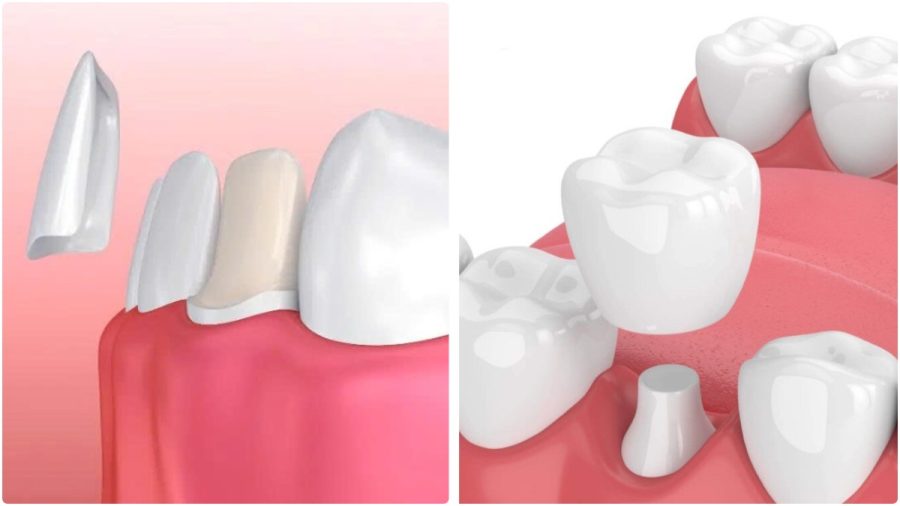 Mô hình đồ họa minh họa sự khác biệt giữa phương pháp dán sứ mỏng nhẹ và bọc sứ bao phủ toàn bộ cùi răng