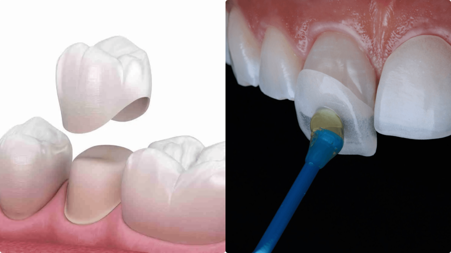 Nên dán sứ hay bọc răng sứ để vừa có nụ cười đẹp chuẩn tỷ lệ, vừa bảo tồn răng thật tối đa?