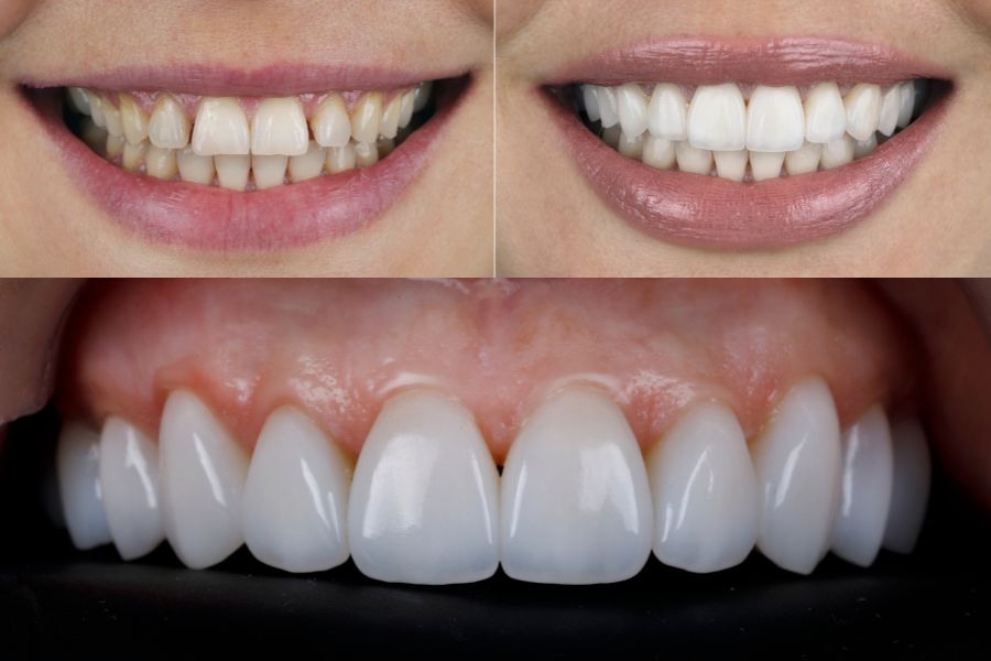 Kết quả thực tế cải thiện nụ cười đều đẹp, trắng sáng tự nhiên sau khi dán sứ thẩm mỹ