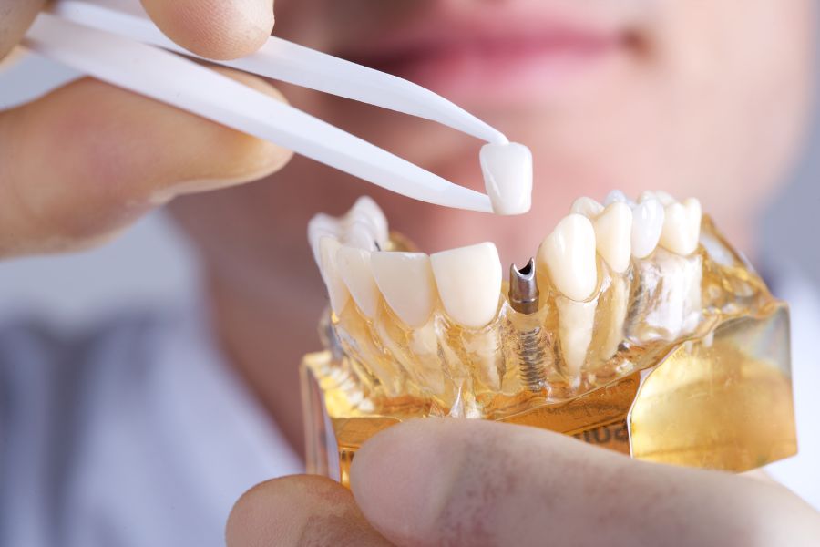 Ứng dụng của dữ liệu CT Cone Beam trong kỹ thuật cấy ghép Implant