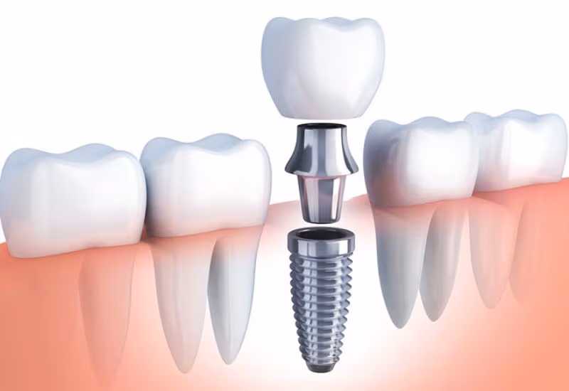 Vì sao cần phục hồi răng đã mất càng sớm càng tốt?