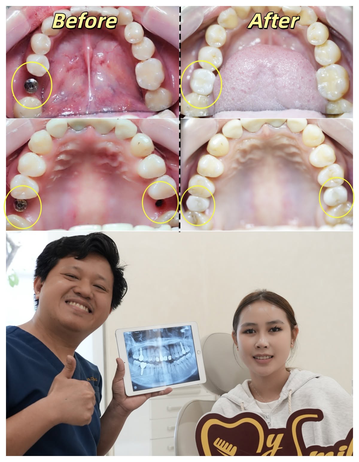 Trường hợp hoàn thành trồng Implant tại Nha khoa My Smile Đà Nẵng