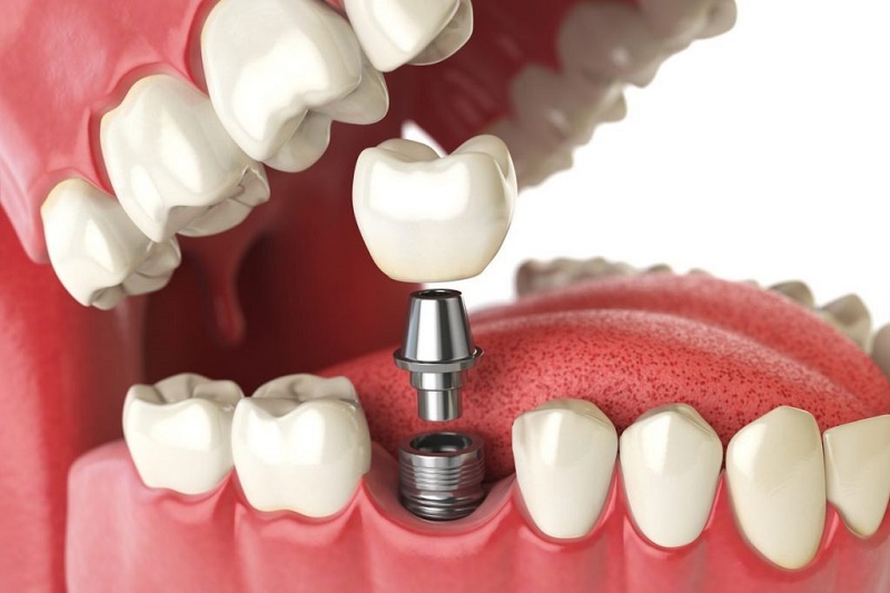 Tiêu chí lựa chọn địa chỉ trồng răng Implant tại Đà Nẵng