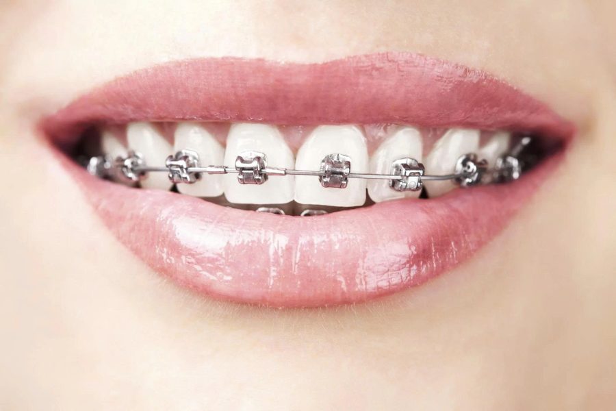 Nụ cười thực tế của khách hàng khi niềng răng bằng mắc cài kim loại tự buộc