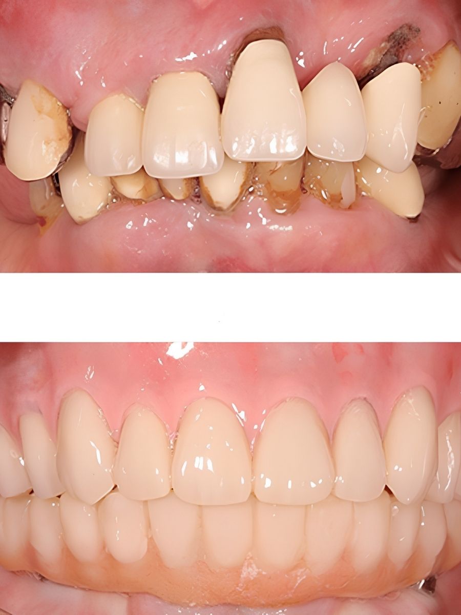 Sự thay đổi rõ rệt của hàm răng trước và sau khi điều trị phục hồi răng mất
