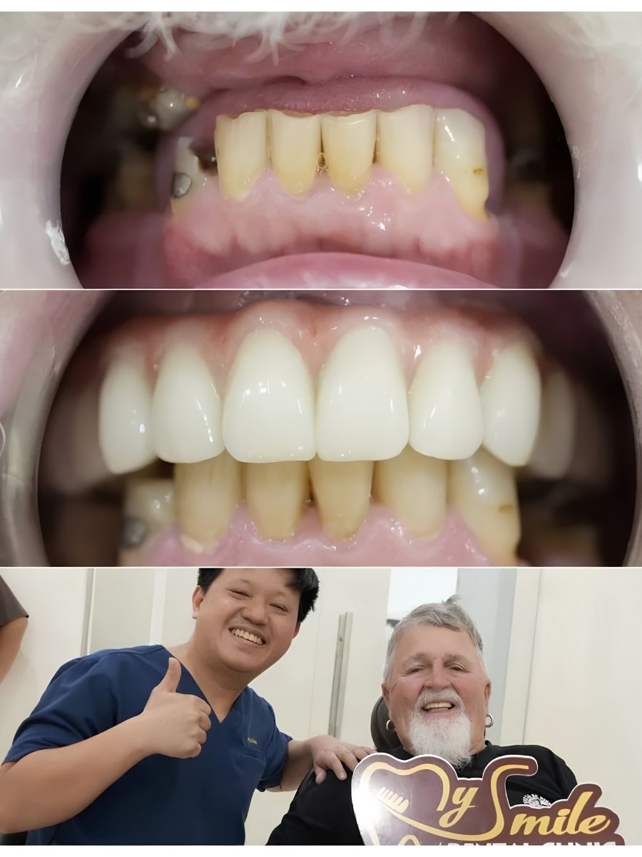 Sự thay đổi ấn tượng của nụ cười và niềm vui khách hàng sau khi phục hình răng sứ