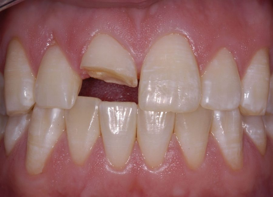 Răng sứ bị vỡ trong quá trình sử dụng sẽ được My Smile bảo hành trong thời gian quy định