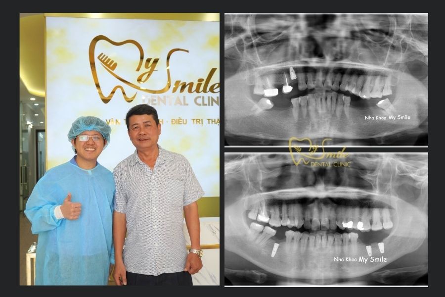 Chính sách bảo hành tại nha khoa My Smile Đà Nẵng