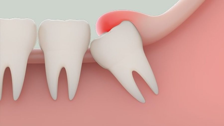 Răng xô lệch do mọc răng khôn sẽ không thuộc phạm vi bảo hành niềng răng