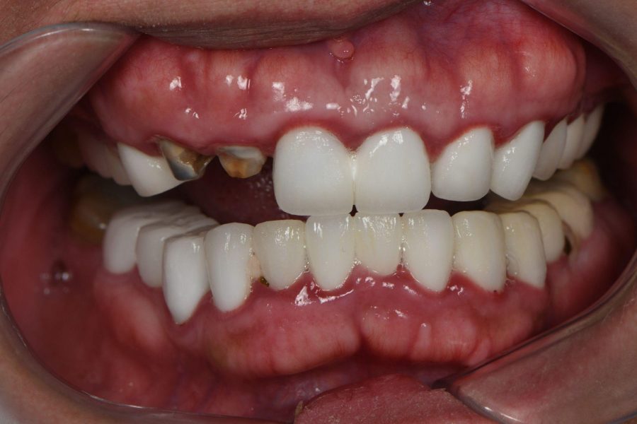 Hình ảnh thực tế khoang miệng tổn thương do cắn vật cứng và sâu răng trụ