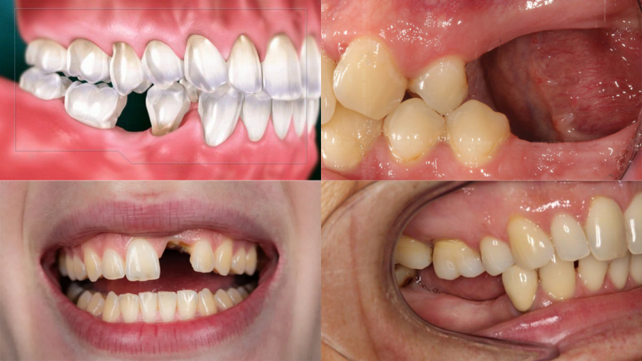 Tình trạng mất một răng hoặc mất nhiều răng cần được thăm khám kỹ lưỡng trước khi cấy ghép.