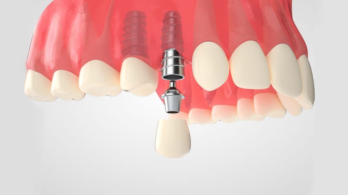 Mô hình cấu trúc trụ Implant Đức tích hợp vững chắc trong xương hàm và mão sứ hoàn thiện