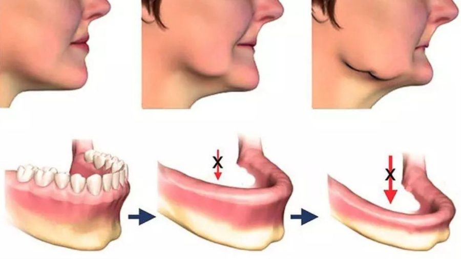 Mô phỏng tình trạng tiêu xương hàm do mất răng lâu ngày và hướng xử lý trước khi trồng Implant