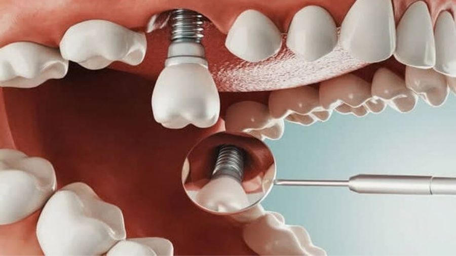 Trồng răng implant Đức tại Đà Nẵng
