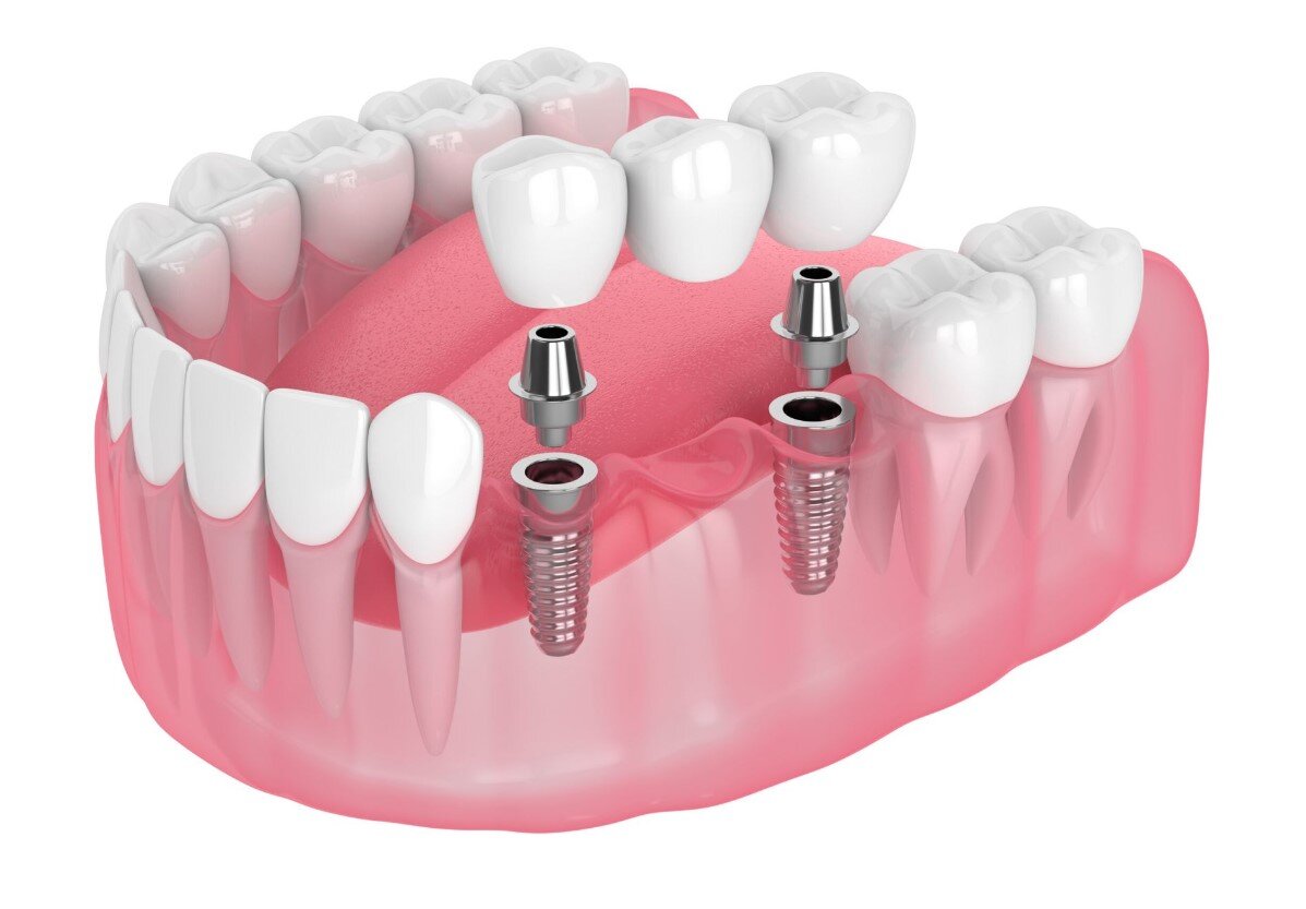 Trồng răng implant Mỹ tại Đà Nẵng