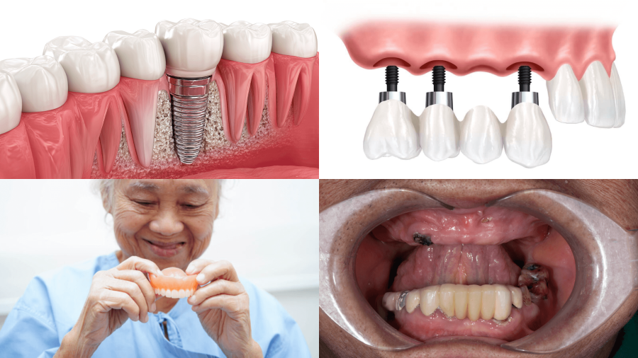 Implant Mỹ phù hợp cho nhiều tình trạng mất răng khác nhau từ mất 1 răng, mất nhiều răng đến mất răng lâu năm