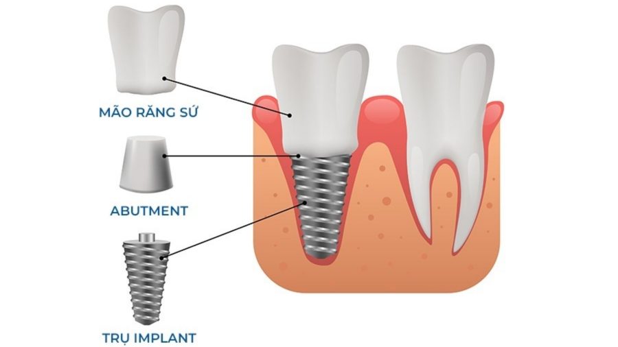 Ba bộ phận chính của một răng implant 