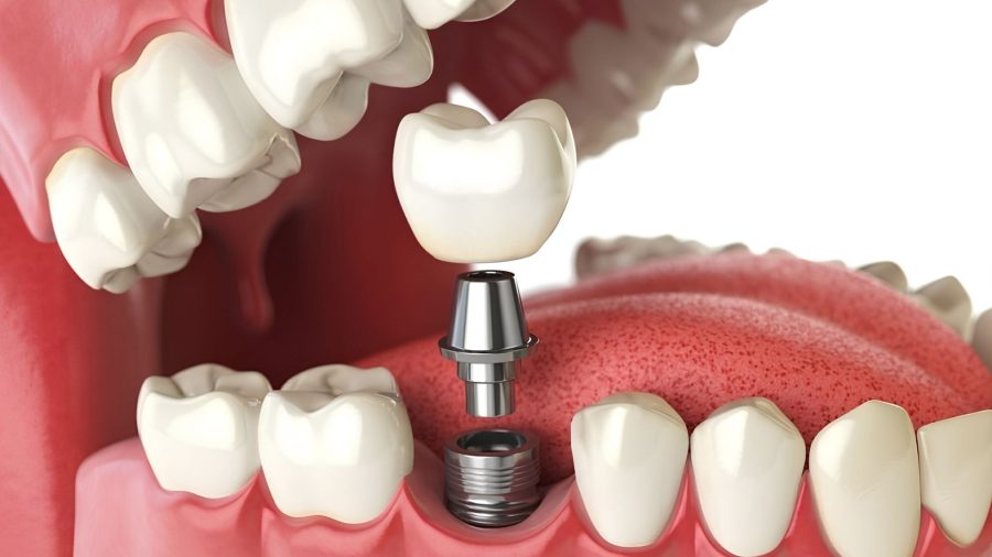 Thao tác lắp gắn Abutment và mão răng sứ để hoàn thiện chiếc răng Implant chuẩn y khoa