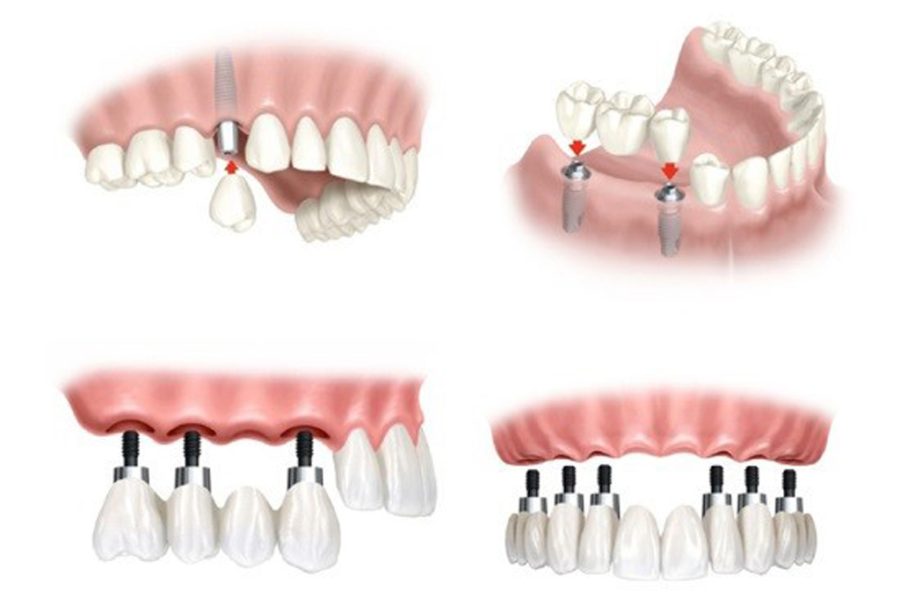 Các phương án cấy ghép Implant đa dạng giúp phục hồi khả năng ăn nhai cho cả trường hợp mất đơn lẻ hoặc mất nhiều răng