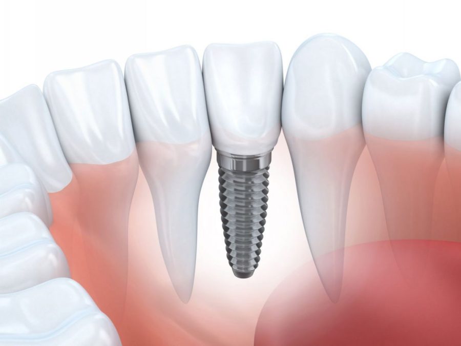 Trụ Implant đặt dưới nướu đóng vai trò như chân răng thật, nâng đỡ răng mà không cần mài các răng kế cận