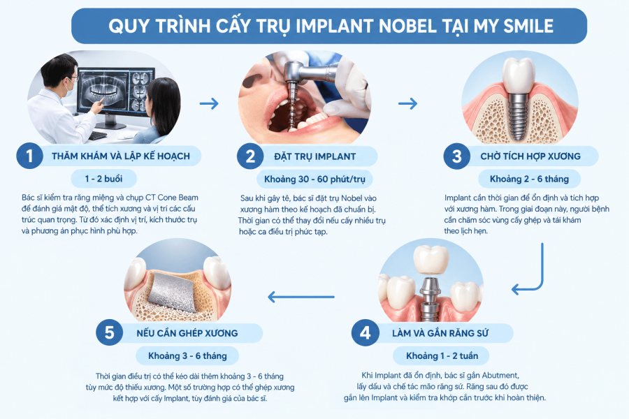 Sơ đồ các bước trồng Implant Nobel và thời gian thực hiện